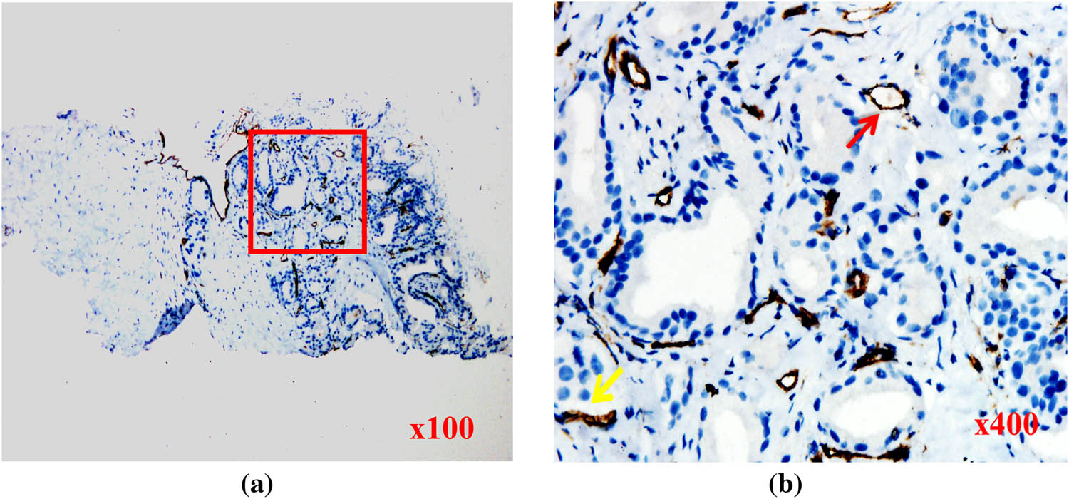 Figure 3 
                  Targeted biopsy tissues from the PCa case with ISUP grade of 2, stained for CD31. (a) Abundant microvessels in tumor tissues (red box). (b) Tumor cell nuclei (blue) were small and poorly differentiated. The numbers of mature vessels (red arrow) and immature vessels (yellow arrow) were almost equal.
               