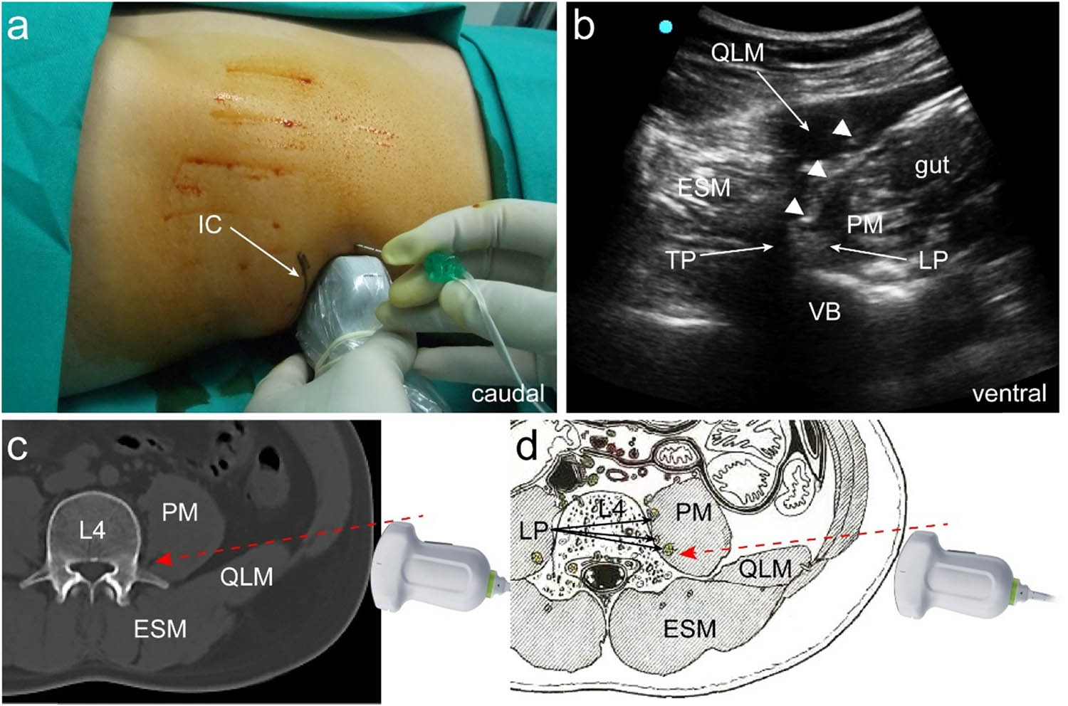 Figure 1
Ultrasound-guided lumber plexus block with short axis in supine position: (a) probe position, (b) ultrasound-guided lumber plexus block in supine position at L4 level, (c) schematic computed tomography diagram of ultrasound-guided lumber plexus block in supine position, and (d) schematic anatomical illustration of ultrasound-guided lumber plexus block in supine position. IC, iliac crest; PM, psoas major muscle; QLM, quadratus lumborum muscle; ESM, erector spinae muscle; VB, vertebral body; TP, transverse process; LP, lumber plexus. Three white triangles point at the trajectory of a needle. Red dotted arrows denote the trajectory of a needle.
