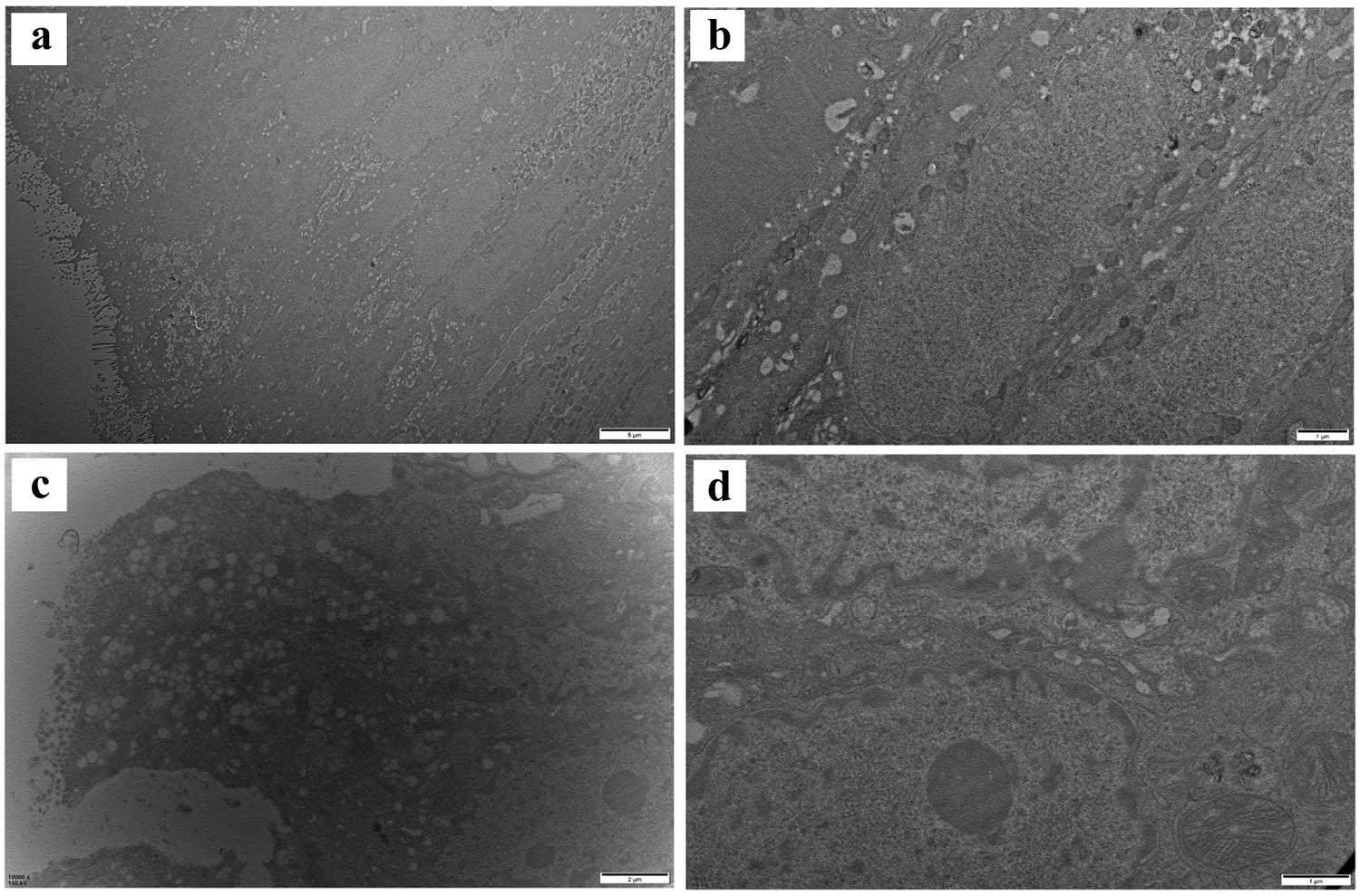 Figure 1
Ultrastructure of intestinal epithelial cells in normal and UC patients: (a) normal control intestinal epithelial cells; (b) connection structure between intestinal epithelial cells; (c) UC intestinal epithelial cells; and (d) intercellular connection structure of UC.