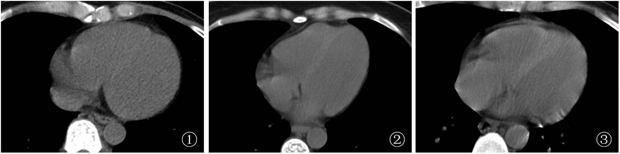 Figure 1 
                  Chest CT images of a HIV-infected patient with anemia (1) A male patient, 44 years old, with mild anemia, HB = 109 g/L, LVD and RVD slightly lower than VSD; (2) A female patient, 42 years old, with moderate anemia, HB = 77 g/L, LVD and RVD lower than VSD; (3) A male patient, 46 years old, with severe anemia, HB = 40 g/L, LVD and RVD significantly lower than VSD.
               