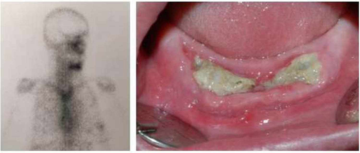Figure 2
Detail of BS that shows a pathological tracer uptake in areas that developed MRONJ 2 months after the BS was performed.