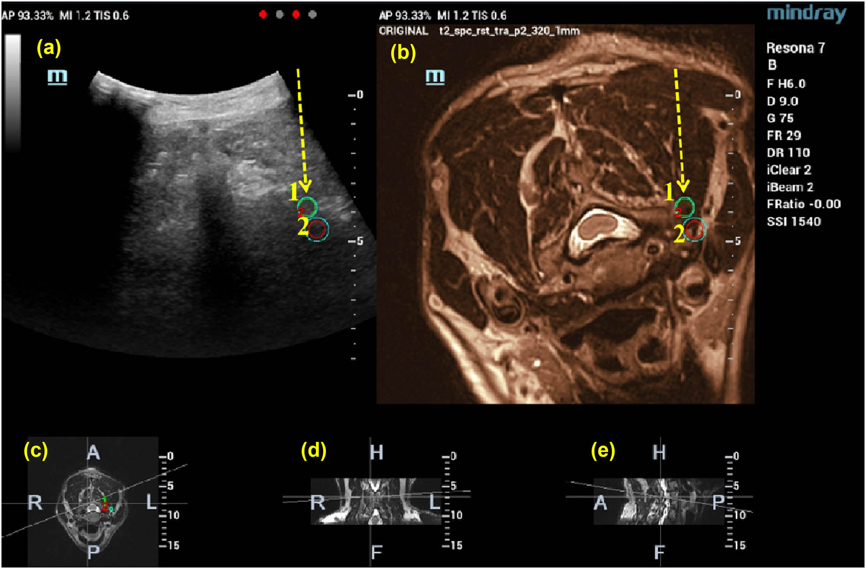 Figure 2 
                     The therapeutic target is marked on the MRI image, and the location of the target is also displayed on the fused image at the same time (1, 2). Then, the puncture path is designed according to the MRI and US images (shown by the yellow arrow). (a) US-MRI fusion images, with green circles indicating the target puncture points, (b)MRI images, (c) cross section, (d) coronal section, and (e) sagittal section.
                  