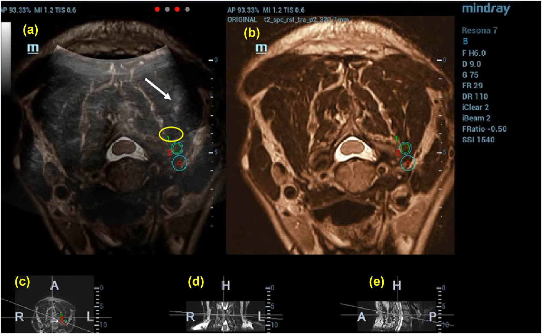 Figure 3 
                     Puncture to preset target 1 guided by US (50%)-MRI (50%) image. The drug solution is injected after the puncture is guided by US (50%)-nuclear magnetic resonance (50%) image; the white arrow indicates the location of the puncture needle and the yellow circle indicates the solutions diffusion range. (a) US-MRI fusion images, with green circles indicating the target puncture points, (b)MRI images, (c) cross section, (d) coronal section, and (e) sagittal section.
                  