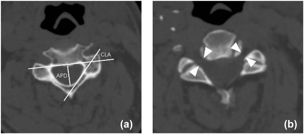 Figure 2 
               Preoperative APD, cord-lamina angle of C4/5 (CLA) (a). Foraminal diameter of C4/5 (FD) (b).
            
