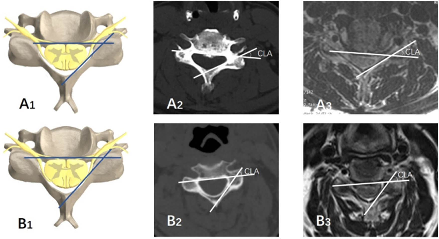 Figure 3 
               Smaller cord-lamina angle (A1, A2, A3) of C5 palsy patient and larger cord-lamina angle (B1, B2, B3) of non-C5 palsy patient.
            