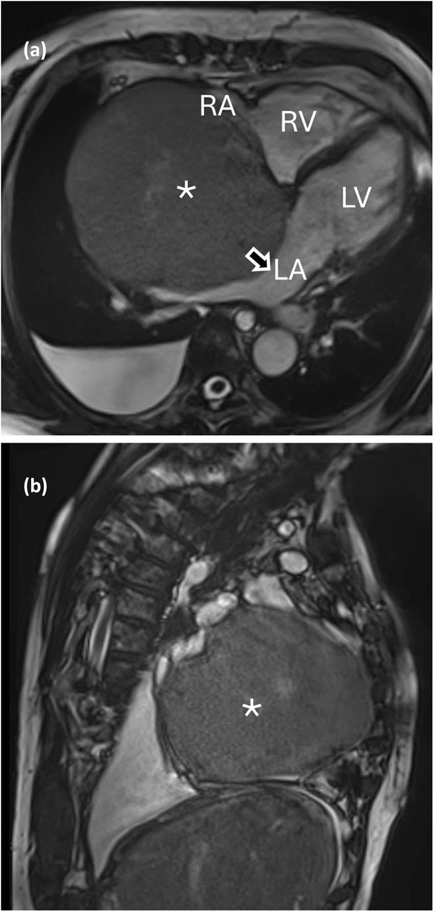 Figure 1 
               (a) and (b) Tumor in the MRI. RV: right ventricle; LV: left ventricle, LA: left atrium, RA: right atrium, arrow: interatrial septum, *: intracardiac mass.
            