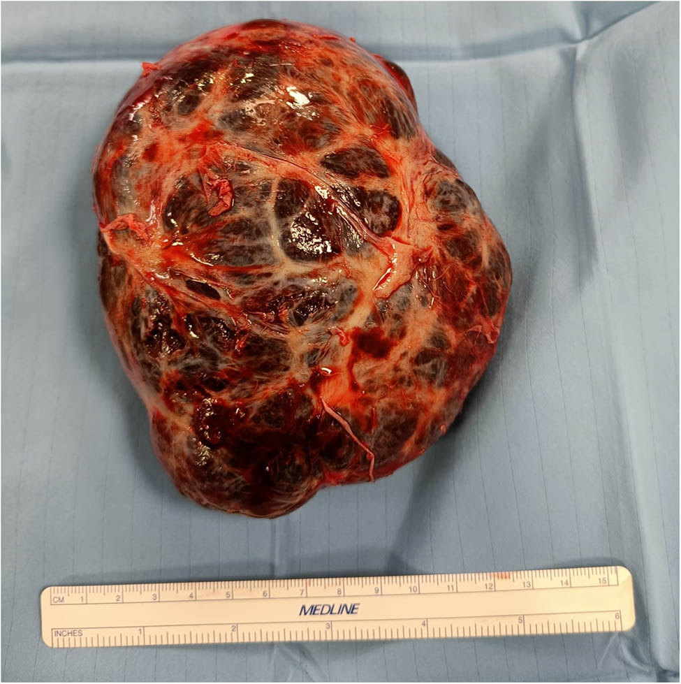 Figure 3 
               Excised mass.
            