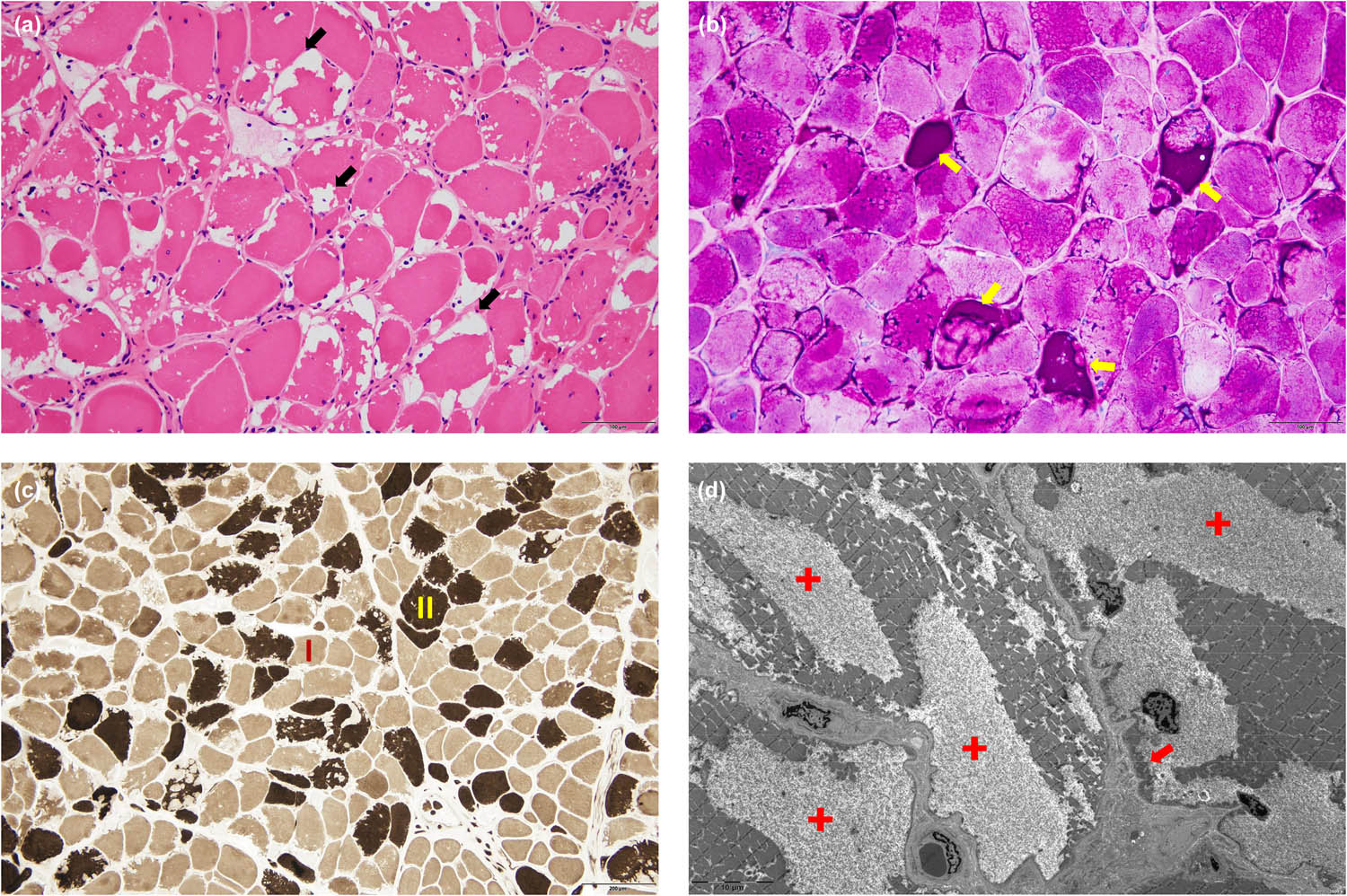 Figure 2
Muscle pathology of the left biceps brachii. (a) HE (200×): marked variation in fiber size, numerous fibers with irregular-shaped sub-sarcolemmal vacuoles (black arrows). (b) PAS (200×): excessive PAS-positive deposits within the vacuoles, indicating the existence of glycogen lakes (yellow arrows). (c) ATPase pH 9.6 (100×): vacuolar fibers involve both type I (light) and type II (dark) muscle fibers. (d) Electron microscopy (2,500×): massive accumulation of glycogen is observed beneath the sarcolemma and between the myofibrils, with most of the glycogen dissolved and glycogen lakes formed (red crosses), while a few glycogen particles (red arrows) remain. ATPase: adenosine triphosphatase; HE: hematoxylin eosin; PAS: periodic acid-Schiff stain.