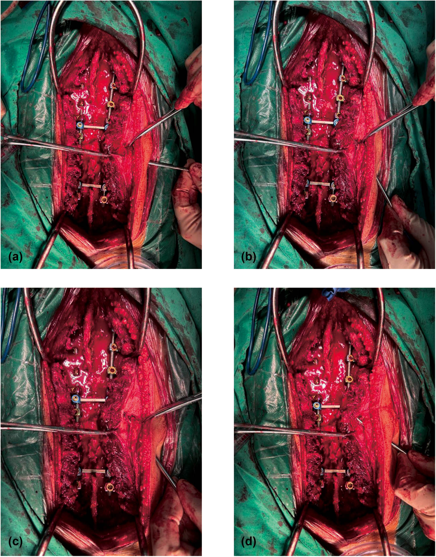 Figure 2
Modified drainage catheter for CSFL during scoliosis surgery. (a) Puncture the needle into the skin and subcutaneous tissue at a 45° angle. (b) The puncture needle was placed 1–2 cm parallel to the surface of the dorsal fascia of the lumbar spine. (c) The needle is inserted into the muscles of the lower back at an angle of 45°, so that the tunnels in the muscles and subcutaneous tissue are arranged in a Z-shape. (d) In the end, the drainage system passes through tunnels in two different levels.