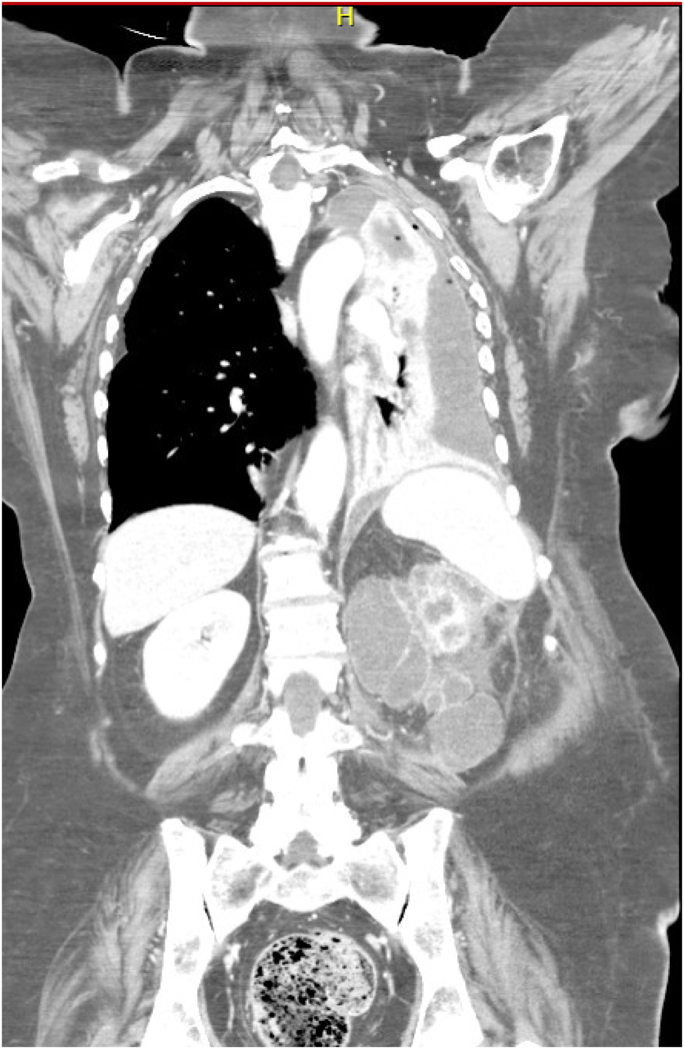 Figure 1:
Preoperative thorax-abdomen contrast-enhanced CT, showing left pleural empyema (35 mm maximum thickness) associated with ipsilateral lung complete atelectasis and left main bronchus caliber abrupt reduction.