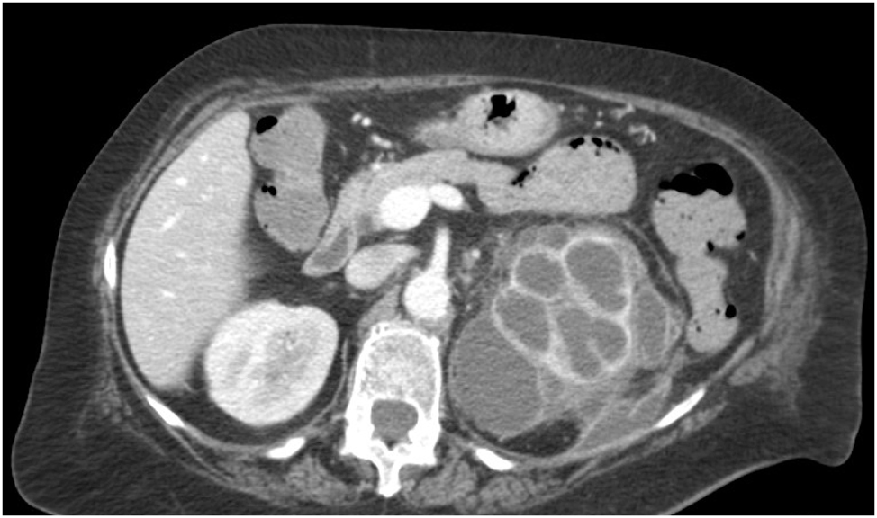 Figure 2:
Preoperative abdomen contrast-enhanced CT, showing the left kidney with a widespread parenchymal density alteration with reduction of the cortico-medullary boundary and “bear-paw sign”.