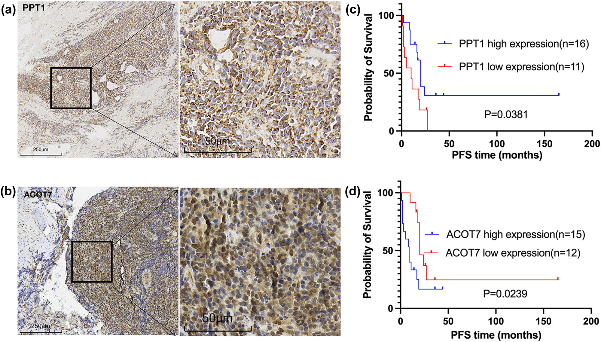 Figure 5 
                  Immunohistochemical validation and statistical analysis of PPT1 and ACOT7. (a) PPT1 expression at magnifications of ×100 and ×400. (b) ACOT7 expression at magnifications of ×100 and ×400. (c) High expression of PPT1 was associated with a longer PFS time in patients with EWS (P = 0.0381). (d) Low expression of ACOT7 was associated with a longer PFS time in patients with EWS (P = 0.0239).
               