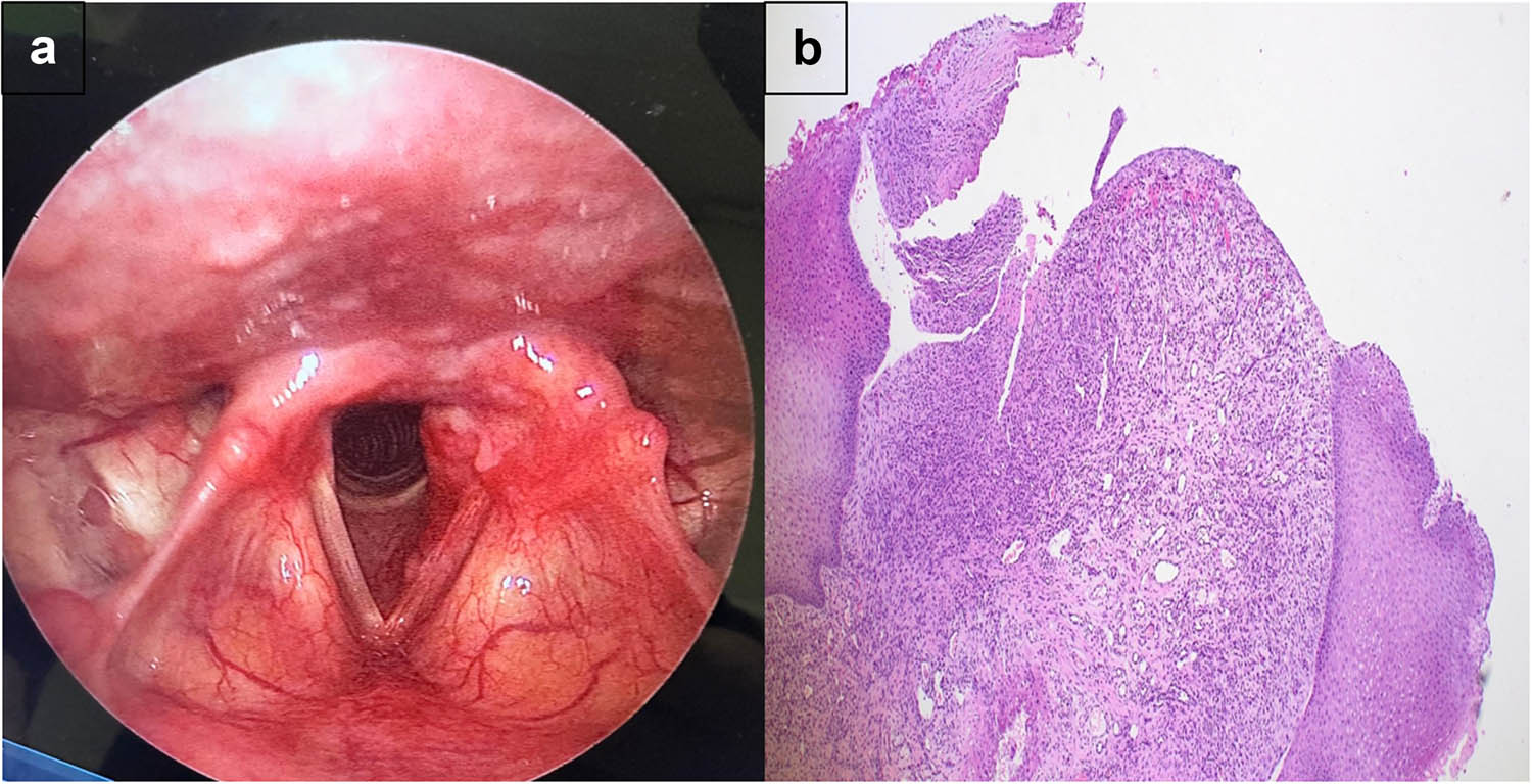 Figure 2 
               Recurrent mass of the vocal cord. (a) Direct laryngoscopy revealing a 2 × 0.5 cm mass with an irregular, granular surface and red coloration, extending from the posterior infraglottic area to the posterior two-thirds of the vocal cord. (b) Light microscopy image of the recurrent vocal cord mass showing surface ulceration with underlying lobular arrangement of capillary vessels (hematoxylin and eosin stain; ×40).
            