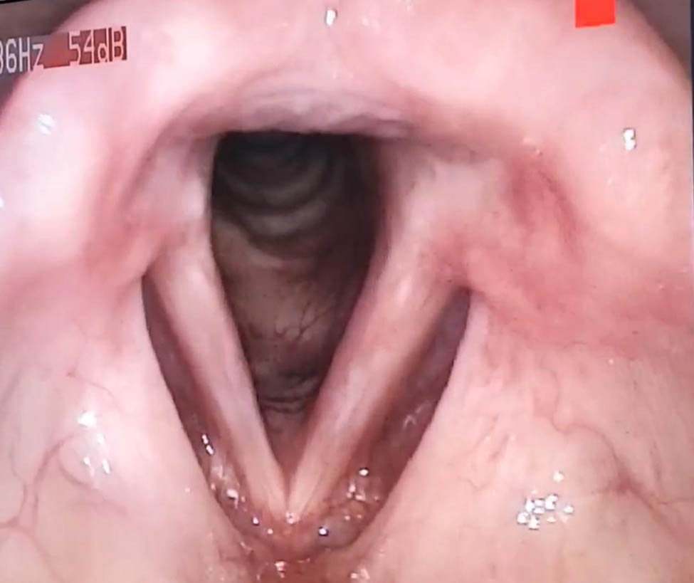 Figure 3 
               Direct laryngoscopy demonstrating remarkable healing of the left vocal cord, with no evidence of mass recurrence 1 year after surgery.
            