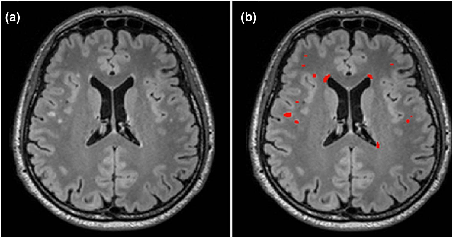Figure 5 
                  Illustration of manual segmentation for WMHs (total WMH volume: 1,835 mm3). (a) Axial T2-weighted FLAIR image from a study subject in his fifth decade. (b) Segmented WMH volume is highlighted in red. The segmentation was performed using ITK-SNAP version 3.6.0. WMH refers to white matter hyperintensity. Reproduced with permission from ref. [13]. Copyright 2021, BMJ Journals.
               