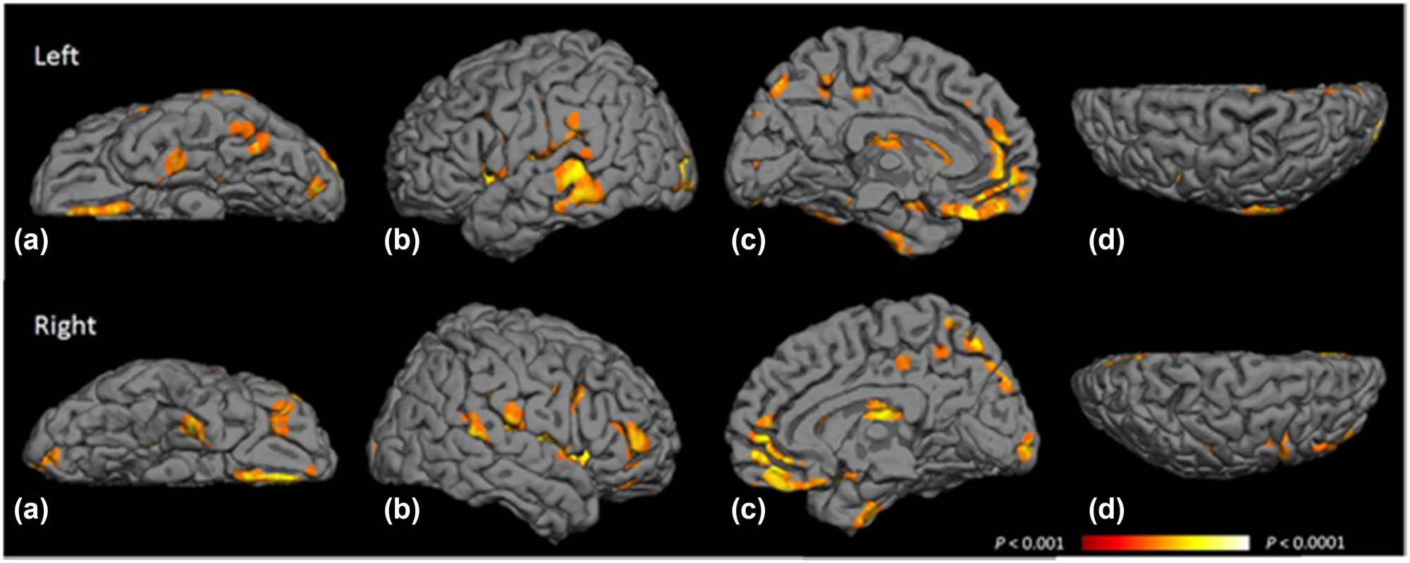 Figure 6 
                  Map depicting the probability of gray matter atrophy due to T2DM. The highlighted voxels represent the brain regions where gray matter atrophy is most probable as a result of T2DM, ranging from a false discovery rate of P < 0.001 (depicted in orange) to P < 0.0001 (depicted in yellow). A comprehensive list of these areas can be found in Table S1. (a) Inferior area, (b) temporal area, (c) medial area, and (d) superior area. Reproduced with permission from ref. [53]. Copyright 2013, Diabetes Care.
               