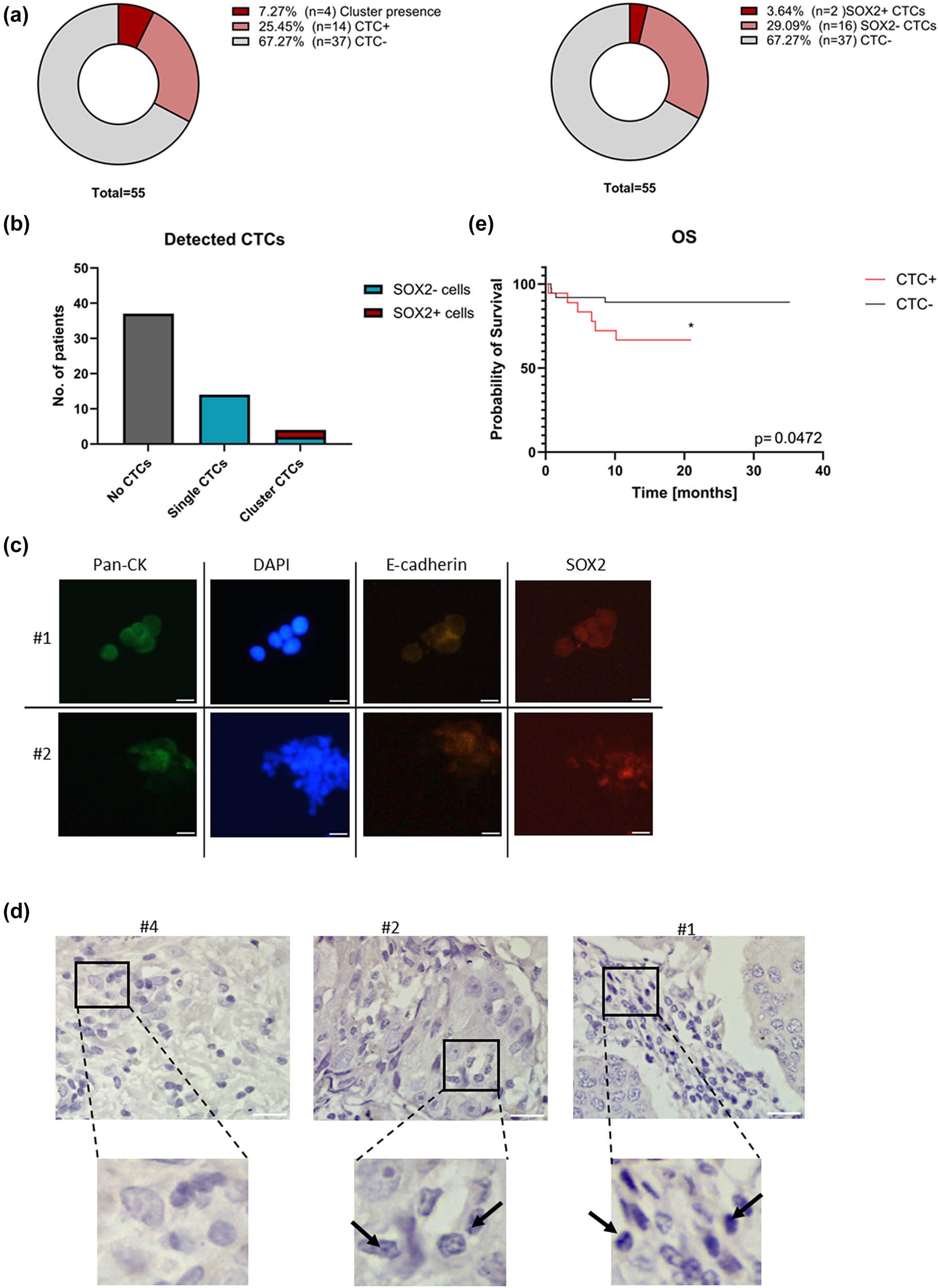 Figure 2
The consolidated data from CTCs detection, where (a) The frequency of CTCs+ patients with detailed CTC clusters positive patients (left panel) and detailed SOX2+ CTCs patients (right panel). (b) The number of patients with SOX2+ CTCs detected; (c) The SOX2+ detected cells in patients; the patient number is stated on the left: #1 and #2. (d) The SOX2 expression detected in the FFPE samples of patients: patient #4 SOX2 negative sample; patient #2 SOX2 positive with low SOX2 expression (red arrows); patient #3 SOX2 positive patient (red arrows). (e) The prognostic value of the detected CTCs for the OS.