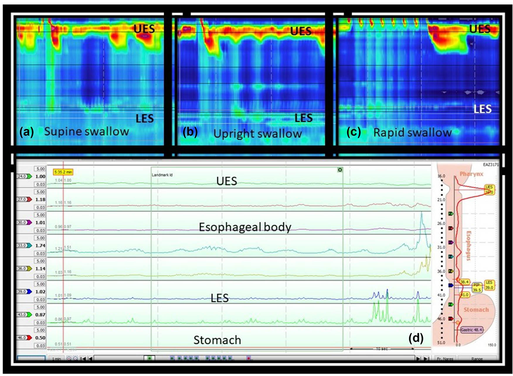 Figure 2 
               High-resolution esophageal manometry showing absent peristalsis with normal LES relaxation both in the supine (a) and upright (b) swallows. Multiple rapid swallow maneuvers demonstrate normal vagal inhibition during rapid swallow and absence of post-rapid swallow peristalsis (c). Baseline impedance analysis (d) revealed normal mucosal impedance (>1 kΩ) in the esophageal body.
            