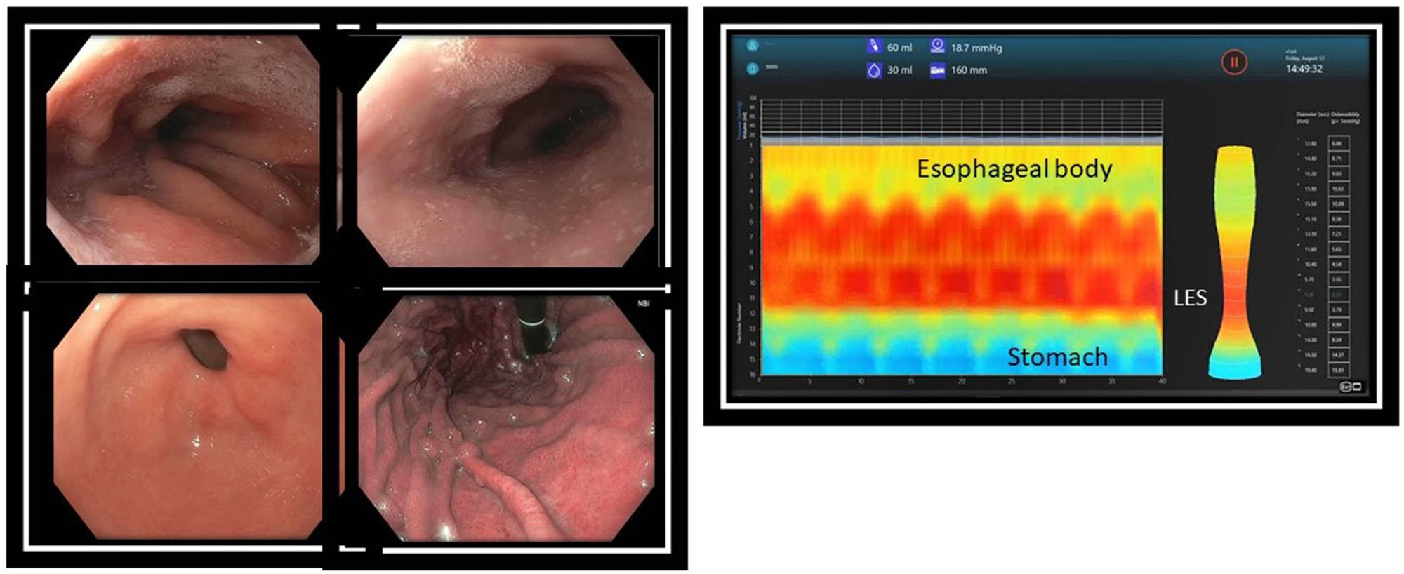 Figure 3 
               Upper endoscopy. Endoscopy revealed small white nummular lesions in the distal esophagus. Biopsies were positive for lichenoid esophagitis and Candida (left panel). EndoFLIP of the esophagus revealed a spastic pattern of esophageal motility without distinct propagated peristaltic activity (right panel).
            