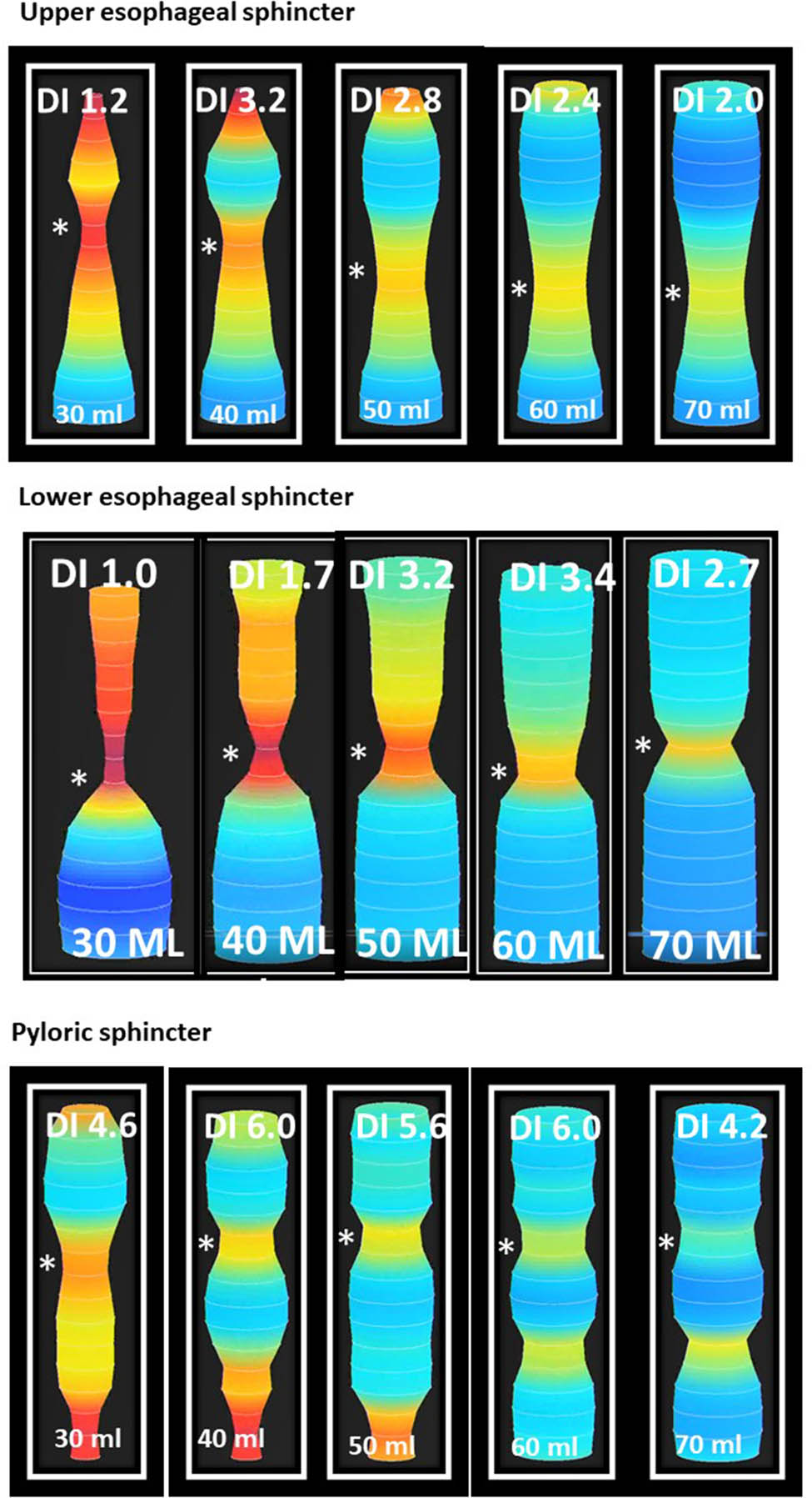 Figure 4 
               EndoFLIP assessment of the esophageal and pyloric sphincters. The figure shows pictures of EndoFLIP testing with distensibility indices of the UES (top), LES (middle), and pyloric sphincter (bottom). The volume of fluid inside the FLIP balloon is mentioned at the bottom of each panel in ml. The distensibility index is mentioned at the top of each panel in mm2/mmHg. The “*” symbol points to the location of the sphincter.
            