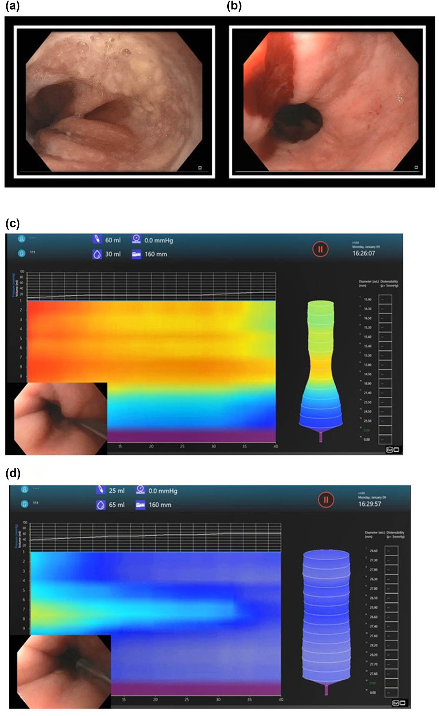 Figure 5 
               Second endoscopy for ongoing dysphagia 5 months after initial endoscopy. There were yellowish plaque-like lesions at the GEJ. Biopsies revealed lichenoid esophagitis without Candida (a). Mucosal bleeding after dilation of the GEJ with EsoFLIP (b). EsoFLIP balloon positioned across the GEJ with 30 ml of fluid in the balloon. This was used to measure the GE junction diameter before starting dilation (c). Maximum inflation leading to obliteration of the waist at the GEJ during EsoFLIP. The volume of fluid in the balloon was 65 ml. Inflation was held for 1 min at this volume before fully deflating the balloon (d).
            