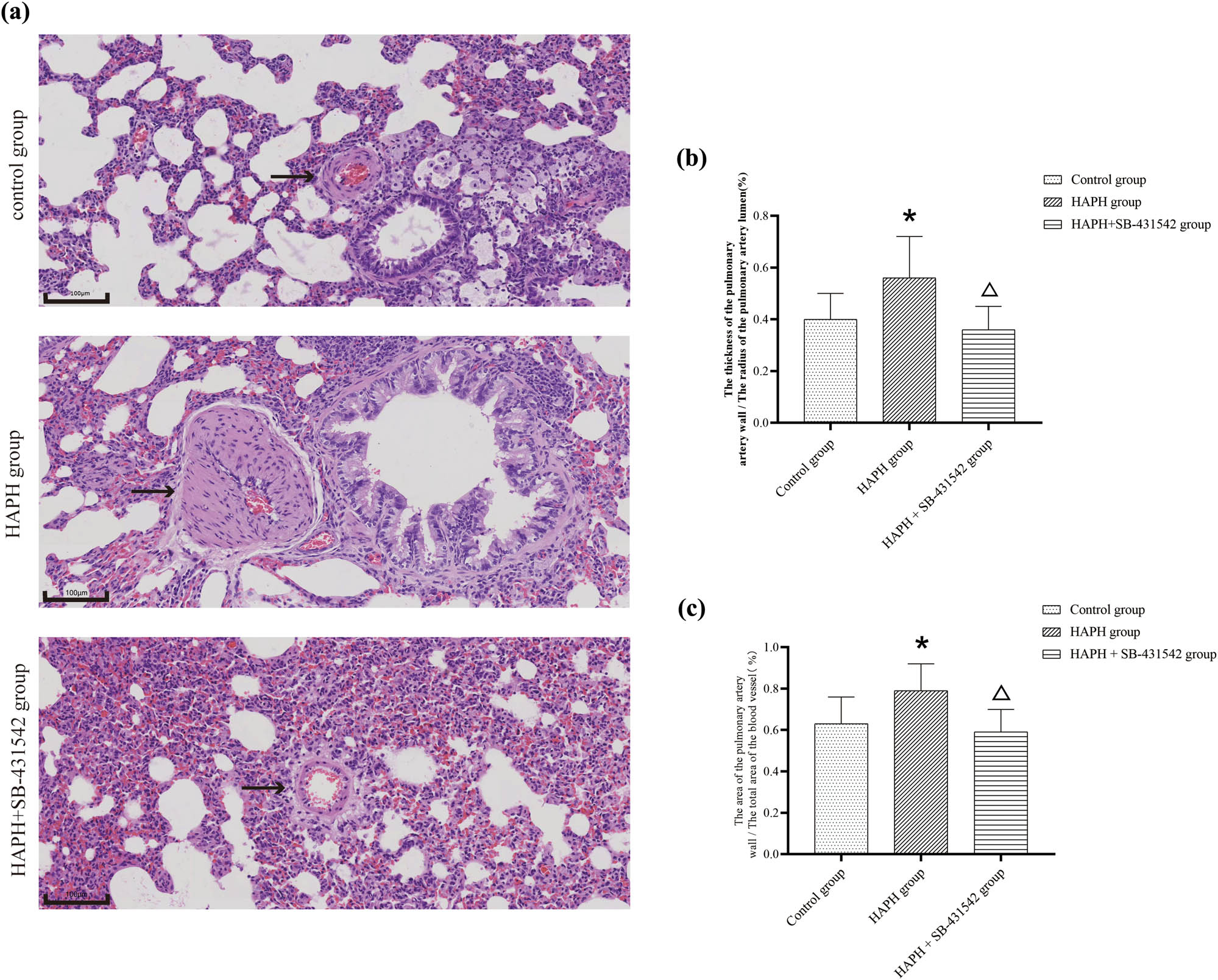 Figure 2 
                  Pathological changes in the lung tissue of HAPH model rats. H&E staining for the detection of morphological changes. The black arrows indicate the pulmonary artery; scale bar, 100 μm (a). Ratio of the pulmonary artery wall thickness to the lumen radius (b). Ratio of pulmonary artery wall area to total pulmonary vessel area (c). Values are presented as mean ± standard deviation. *p < 0.05 compared to the control group; Δp < 0.05 compared to the HAPH group. Abbreviations: HAPH, high-altitude pulmonary hypertension; H&E, hematoxylin and eosin; SD, standard deviation.
               
