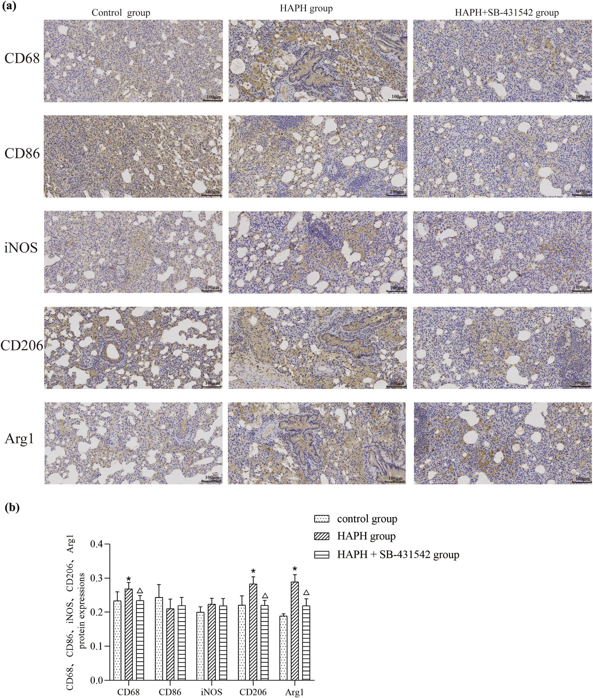 Figure 3 
                  Representative images showing CD68, CD86, CD206, iNOS, and Arg1 expression; scale bar, 100 μm (a). Quantitative analysis of positive cell density (b). Values are presented as mean ± standard deviation. *p < 0.05 compared to the control group; Δp < 0.05 compared to the HAPH group. Abbreviations: CD, cluster of differentiation; iNOS, inducible nitric oxide synthase; Arg1, arginase 1; SD, standard deviation.
               