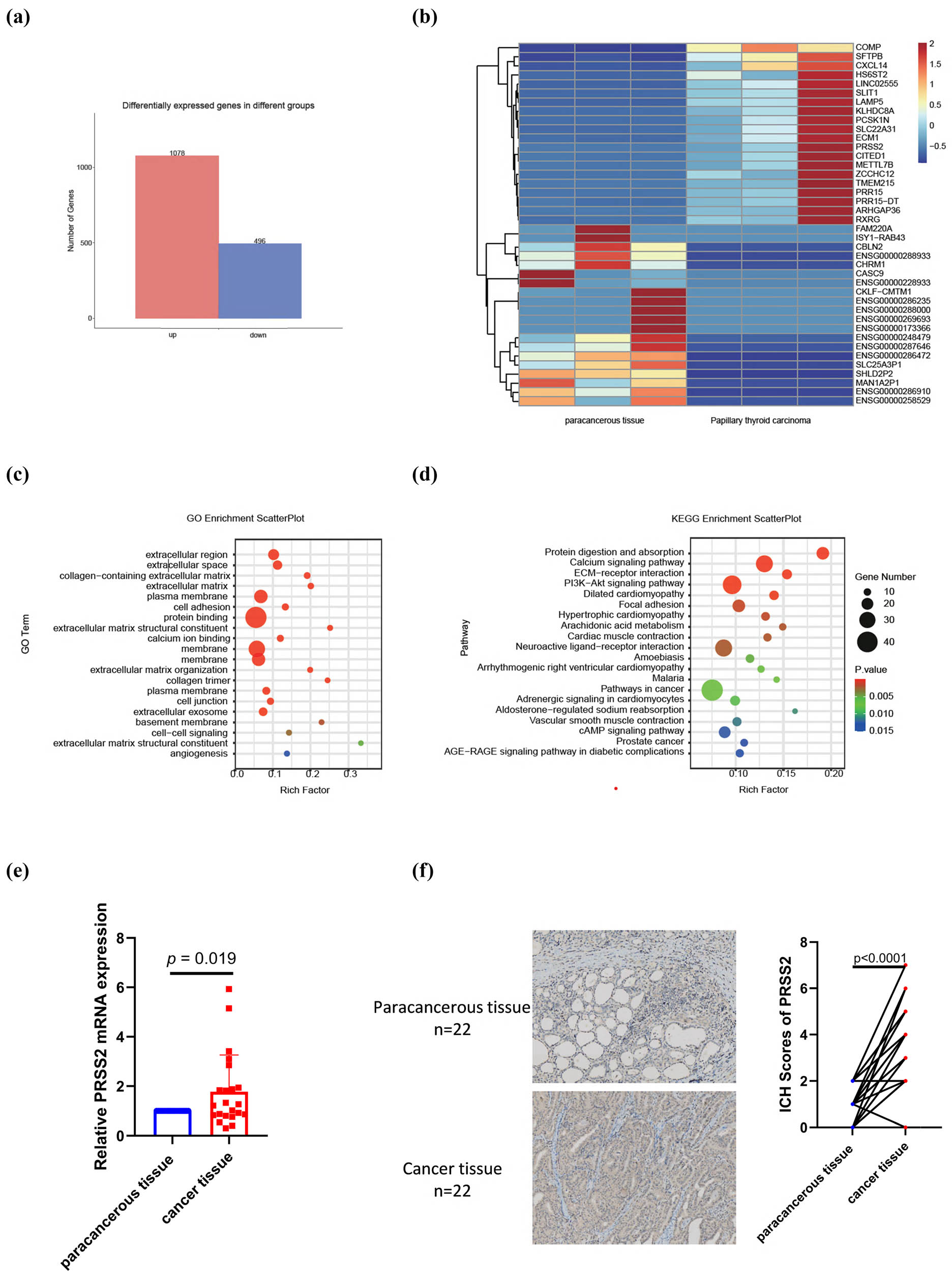 Figure 1 
                  PRSS2 expression in papillary thyroid carcinoma. (a) Statistical analysis and (b) clustering heatmap of DEGs based on RNA-seq data comparing PTC tissues and adjacent non-tumorous tissues. (c) GO enrichment analysis and (d) KEGG pathway classification and functional enrichment of the DEGs. (e) qRT-PCR and (f) immunohistochemical analysis of PRSS2 expression in PTC and adjacent non-tumorous tissues.
               