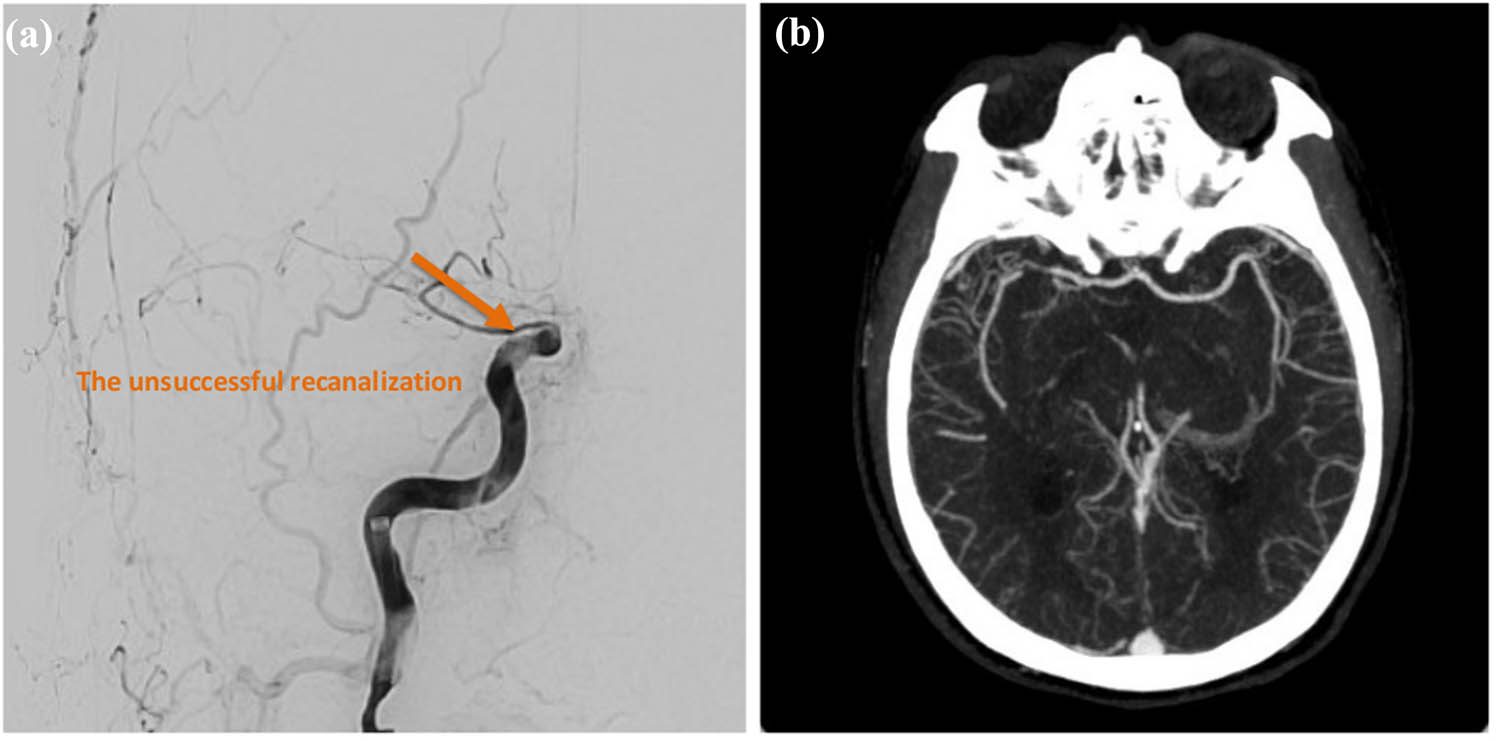 Figure 2 
               Endovascular thrombectomy findings. (a) Digital subtraction angiography reveals acute occlusion of the distal segment of the right ICA. (b) Post-procedural angiography demonstrates unsuccessful recanalization, with a mTICI score of 0, indicating persistent occlusion. Infarction involving the basal ganglia is also noted. Orange arrow: The orange arrow denotes an area of unsuccessful recanalization.
            