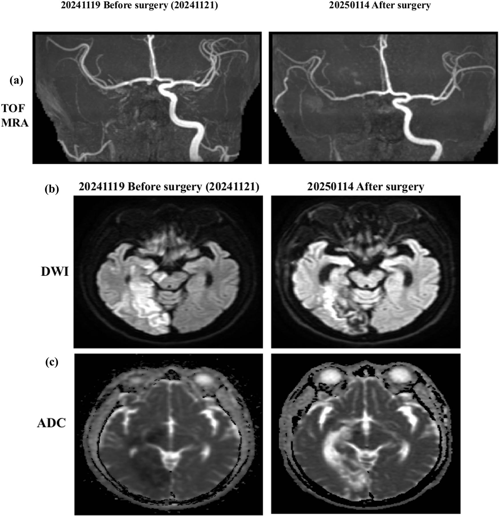 Figure 3 
               Serial neuroimaging before and after STA–MCA bypass surgery. (a) TOF MRA performed on November 19, 2024 (preoperative), demonstrates occlusion of the right ICA with reduced distal perfusion. Follow-up MRA on January 14, 2025 (postoperative), shows improved collateral circulation in the MCA territory, consistent with successful revascularization via STA–MCA bypass. (b) Diffusion-weighted imaging (DWI) prior to surgery reveals hyperintense signals in the right hemisphere, indicating acute ischemic changes. Postoperative DWI shows no new hyperintensities, suggesting the absence of additional infarcts. (c) Apparent diffusion coefficient (ADC) maps demonstrate corresponding preoperative hypointensities, confirming restricted diffusion in infarcted regions. Postoperative ADC findings reflect infarct maturation without evidence of extension.
            