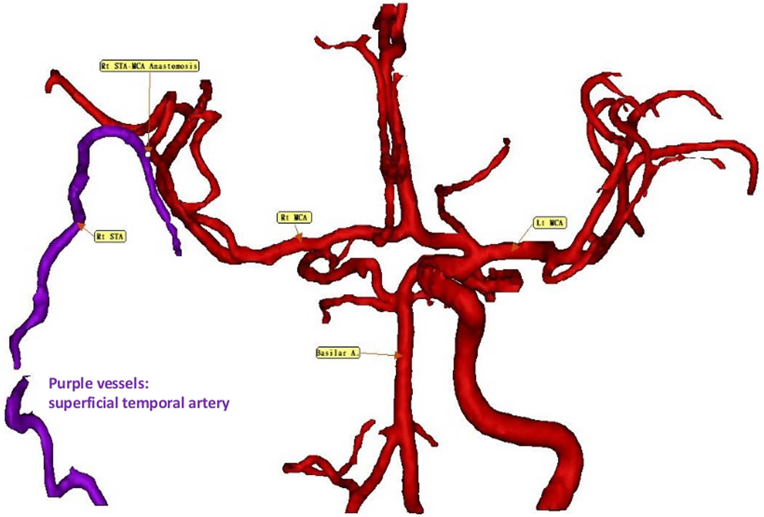 Figure 4 
               Three-dimensional reconstructions of the cerebral vasculature. Follow-up imaging on January 14, 2025, after STA–MCA bypass surgery, reveals improved cerebral perfusion. No new ischemic lesions are observed, confirming the absence of perioperative infarcts. Purple vessels: STA.
            