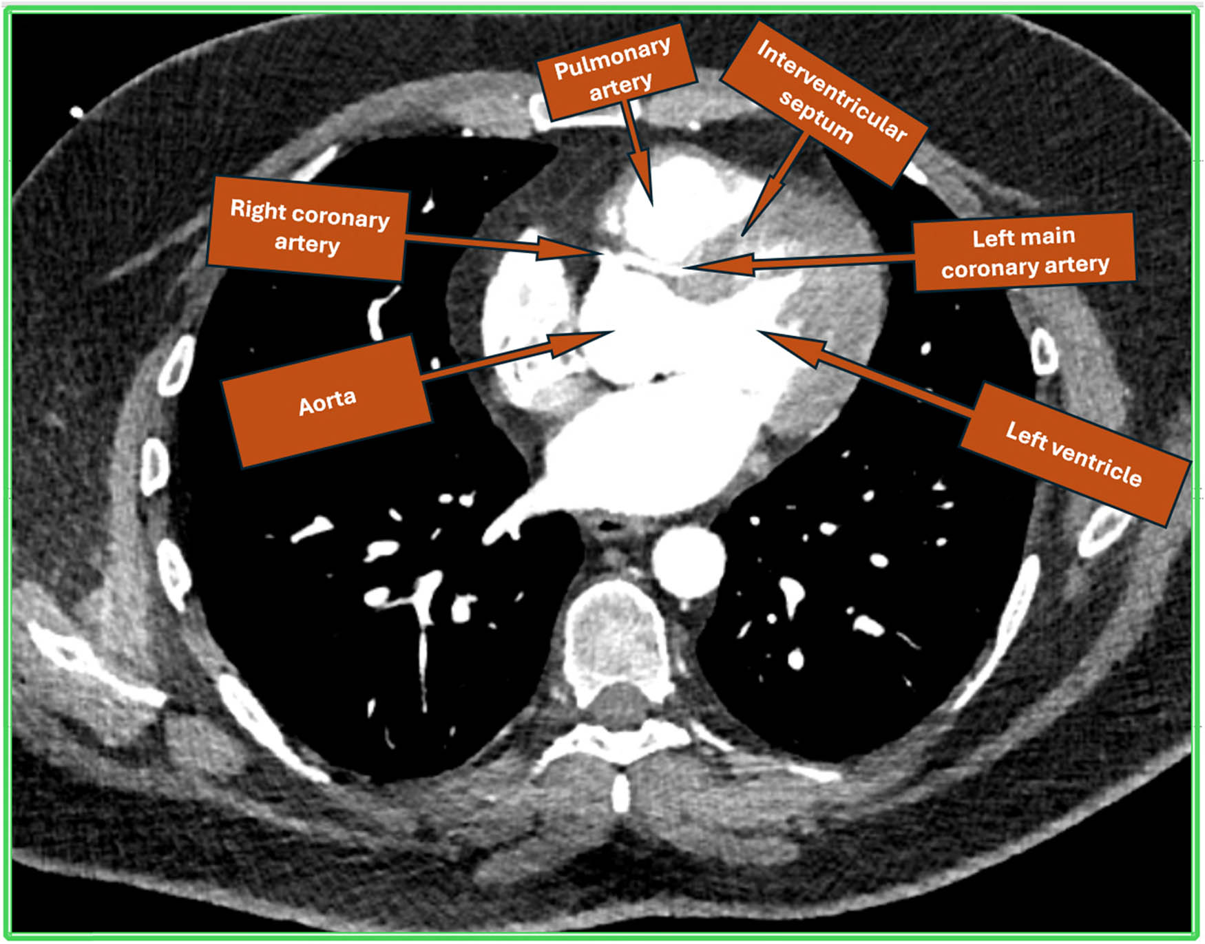Figure 1 
               Cardiac computed tomogram showing single coronary origin from right coronary cusp and LCA having inter-arterial course between aorta and PA followed by course in the interventricular septum.
            