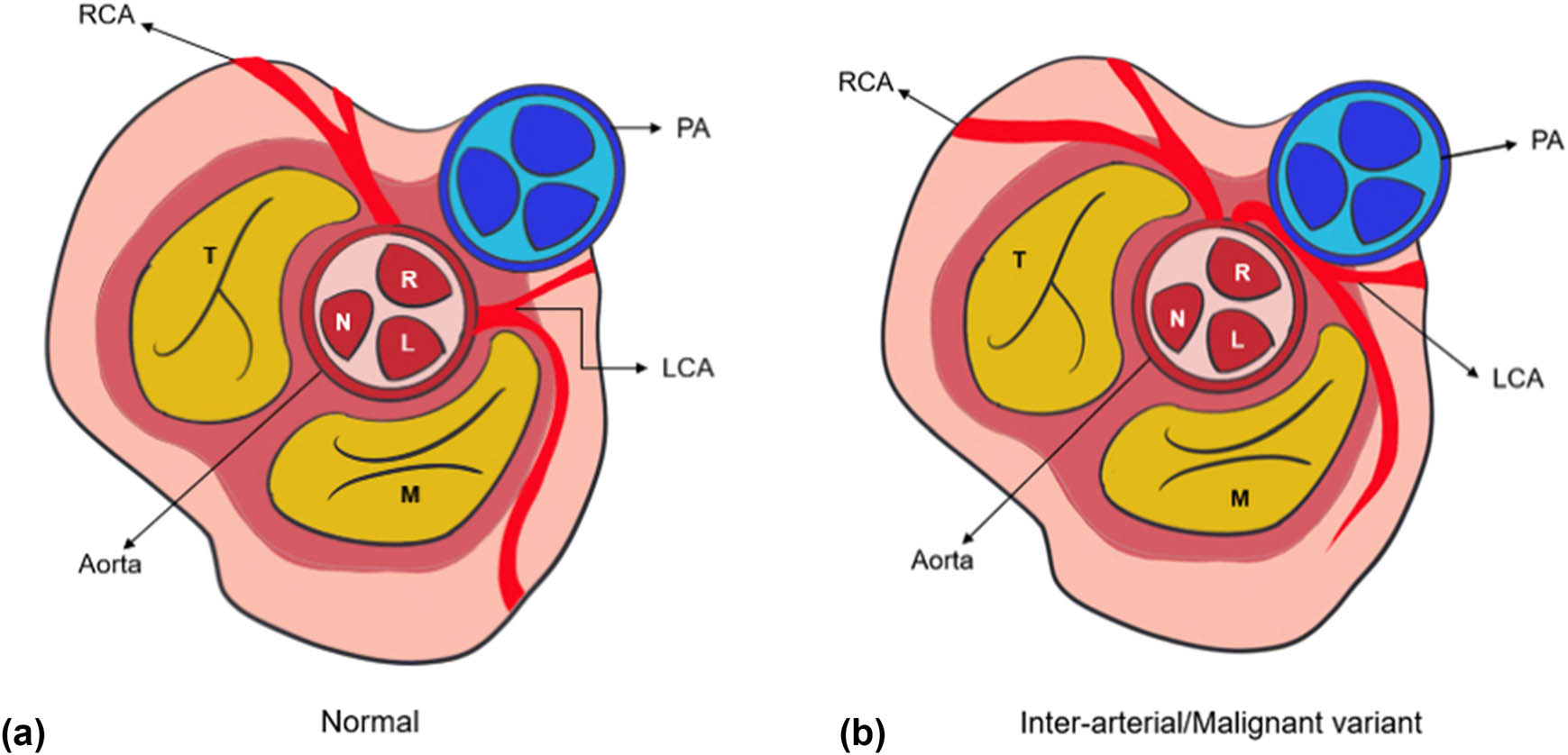 Figure 3 
               (a) Schematic representation of normal coronary anatomy, with LCA arising from left aortic sinus of Valsalva. (b) Schematic representation of anomalous origin of LCA arising from RASV. RCA: right coronary artery; PA: pulmonary artery; LCA: left coronary artery; R: right sinus of Valsalva; L: left sinus of Valsalva; N: non-coronary sinus; M: mitral valve, T: tricuspid valve.
            