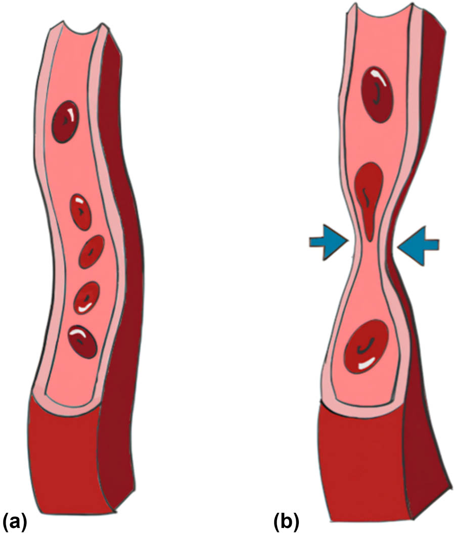 Figure 4 
               (a) Schematic representation of normal LCA with a wide and unobstructed lumen. (b) Schematic representation of the inter-arterial LCA, being compressed by the major arteries.
            