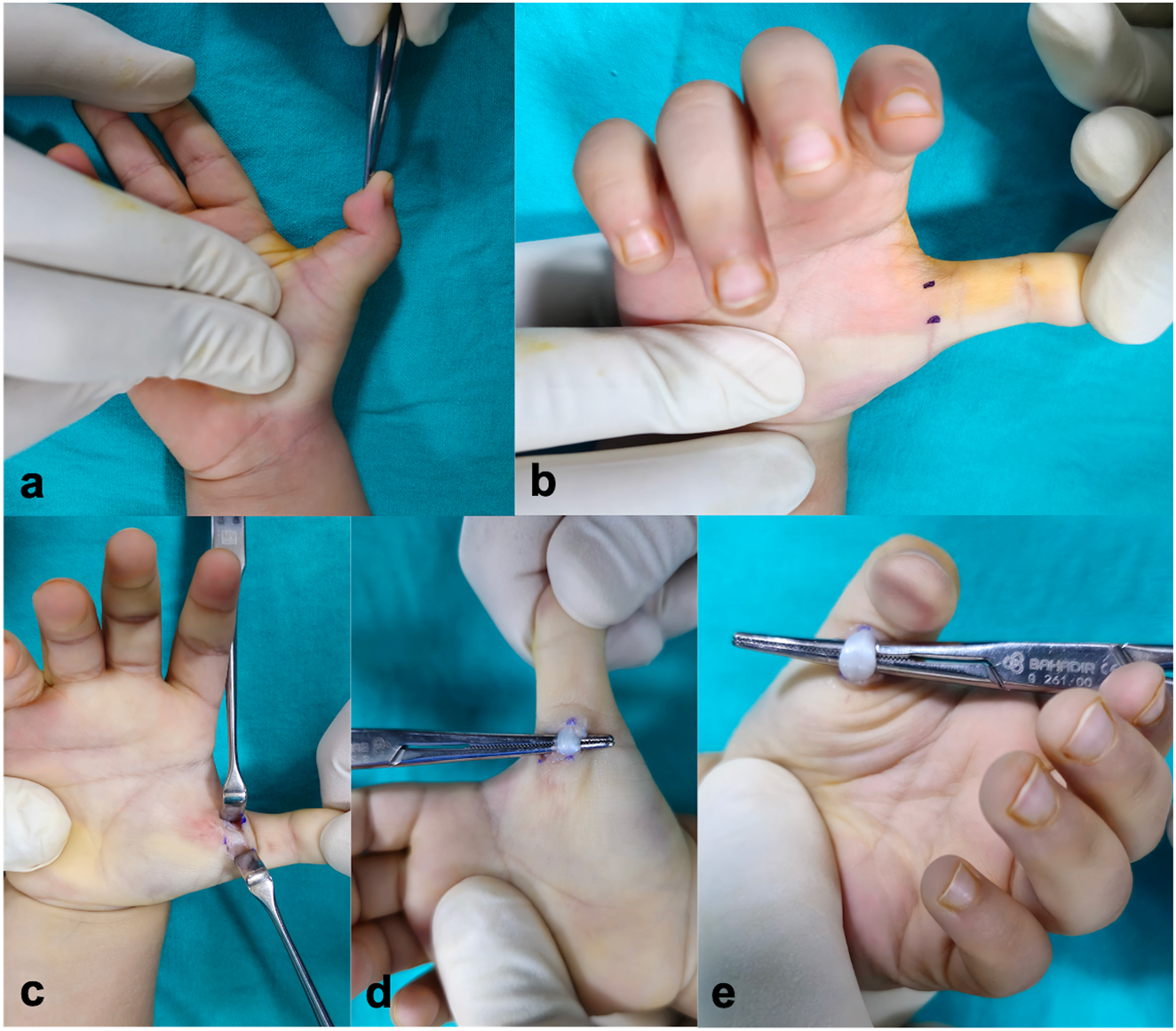 Figure 1:
Open A1 pulley release. (a) Preoperative view showing fixed flexion contracture of the thumb. (b) Intraoperative marking of Notta’s nodule and the flexor tendon pathway. (c) Exposure of the A1 pulley achieved through appropriate retraction. (d) Passive thumb extension used to confirm complete tendon release following A1 pulley division. (e) Passive flexion of the interphalangeal joint to verify smooth tendon gliding after release.