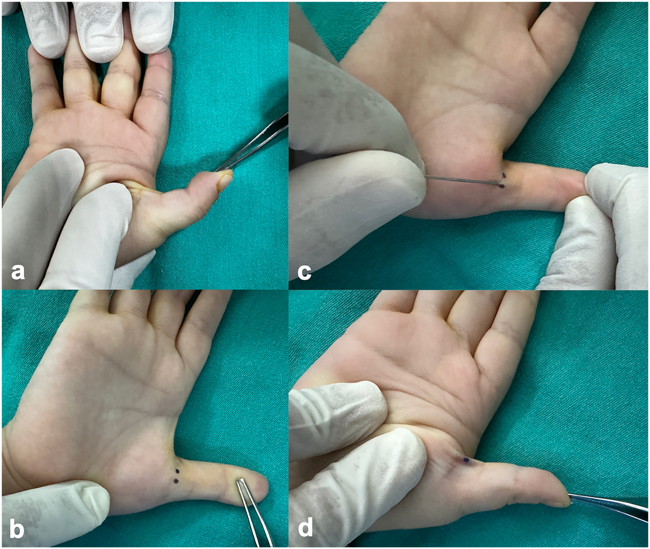 Figure 2:
Percutaneous A1 pulley release. (a) Preoperative presentation of a fixed flexion contracture in the thumb. (b) Intraoperative identification of Notta’s nodule and the flexor tendon pathway, followed by marking and selection of the needle entry site. (c) Percutaneous division of the A1 pulley performed by inserting the needle just distal to the nodule and applying longitudinal sweeping movements. (d) Intraoperative assessment of tendon release through passive extension of the thumb.