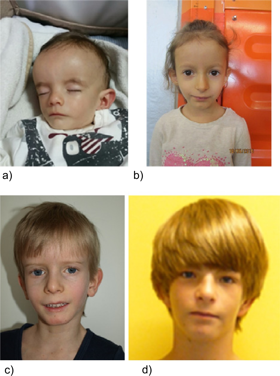 Figure 2 Patients referred for SRS testing and molecular diagnosis of IC2 LOM. Though the patients exhibit similar features, they illustrate the variable range of mosaicism as well as the possible occurrence of MLID. (a) One-year-old boy, IC2 LOM not detectable in blood, but in buccal swab DNA, NH-CSS: 5/5 criteria (by courtesy of V. Tasic). (b) Five-year-old girl, IC2 LOM in blood, NH-CSS: 3/3 criteria (only 3 criteria could be documented). (c) Eight-year-old boy, IC2 LOM in blood, NH-CSS: 6/6 criteria (by courtesy of C. Schröder). (d) Eighteen-year-old boy, MLID and IC2 LOM in blood, NH-CSS: 5/5 criteria.
