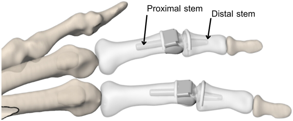 Figure 2: 
Illustration of the PIP joint when inserted in cadaver between proximal phalanges and intermediate phalanges.
