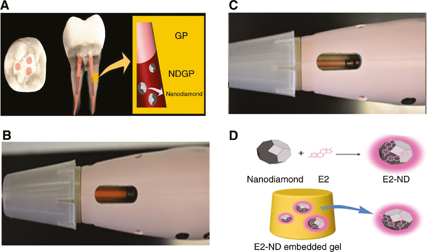 Figure 5: Clinical applications of nanodiamonds.(A) An illustration of NDGP in the middle third of the root canal and unmodified GP in the apical and coronal thirds of the root canal-treated tooth. (B) A view of unmodified GP in the dispensing unit. (C) A view of NDGP in the dispensing unit. Adapted from [78]. (D) A schematic of E2/ND complex embedded within a hydrogel matrix. Adapted from [79].