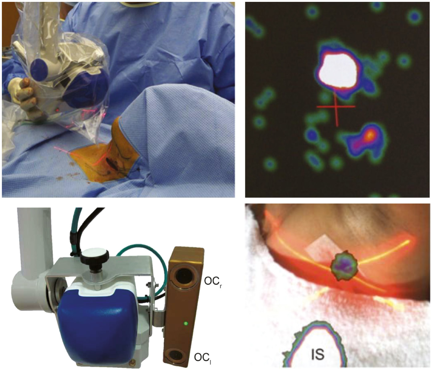 Figure 7: Optical images help surgeons to better localize SLNs in patients.The laser pointer can work as a reference to localize the center of FOV in the image and patient (top). Reproduced with permission from [92]. Optical cameras mounted beside commercial systems can be used to overlay both images on display using image processing methods (bottom). Reproduced with permission from [34], [93].
