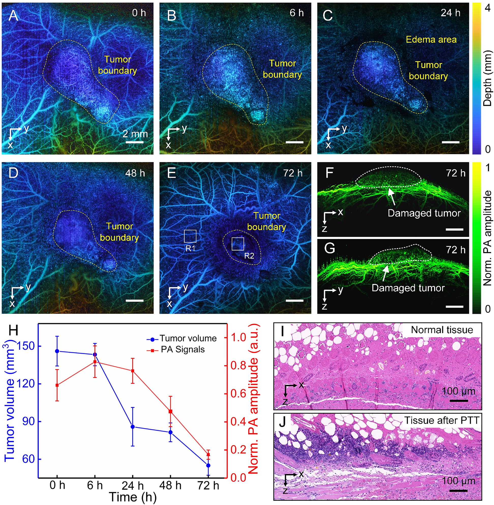 Figure 6: 

In vivo photothermal therapy after injection through the tail vein.
(A)–(E) The microvasculature was imaged at different timing to evaluate the therapeutic effect. (F) and (G) The tomographic projection images of the tumor region at 72 h after treatment. (H) Tumor volumes and PA signals amplitude at different timing after treatment. (I) Image with H&E staining histopathology of normal tissue around the tumor (R1) in Figure E. (J) Image with H&E staining histopathology in tumor site (R2) in Figure E.

