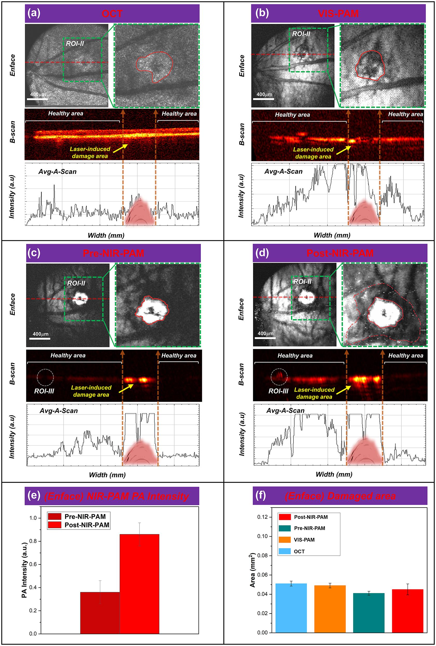 Figure 5: 
FINPs enhanced NIR-PAM and OCT imaging in CNV model rats. (a)–(d) OCT, VIS-PAM, pre-NIR-PAM, and post-NIR-PAM en face and B-scan image of rat fundus with nanoparticle injection. (e) The NIR-PAM signal amplitudes were enhanced 236.6 % from 0.363 (a.u.) to 0.859 (a.u.) at 3 min after injection. (f) ImageJ software to quantitatively analyze the laser-induced area.

