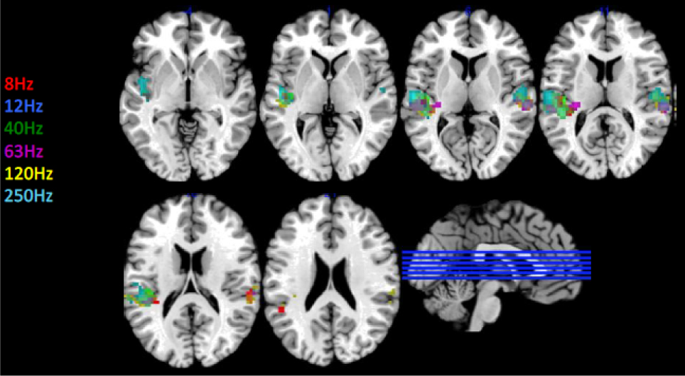 Figure 2 Sample activation of auditory cortex during stimulation of the ear by low-frequency sound and infra-sound (courtesy of Christian Kock, Physikalisch-Technische Bundesanstalt (PTB)). The brain activation at stimulus frequencies between 8 Hz and 250 Hz is detected by using fMRI images in various sectional planes through the brain.