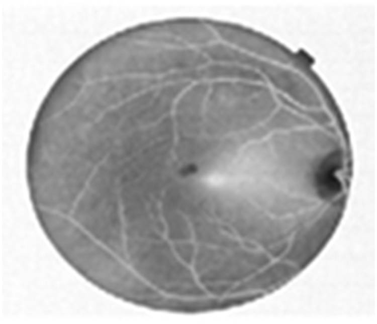 Figure 3 
               Blood vessel enhanced image using CLAHE.
            