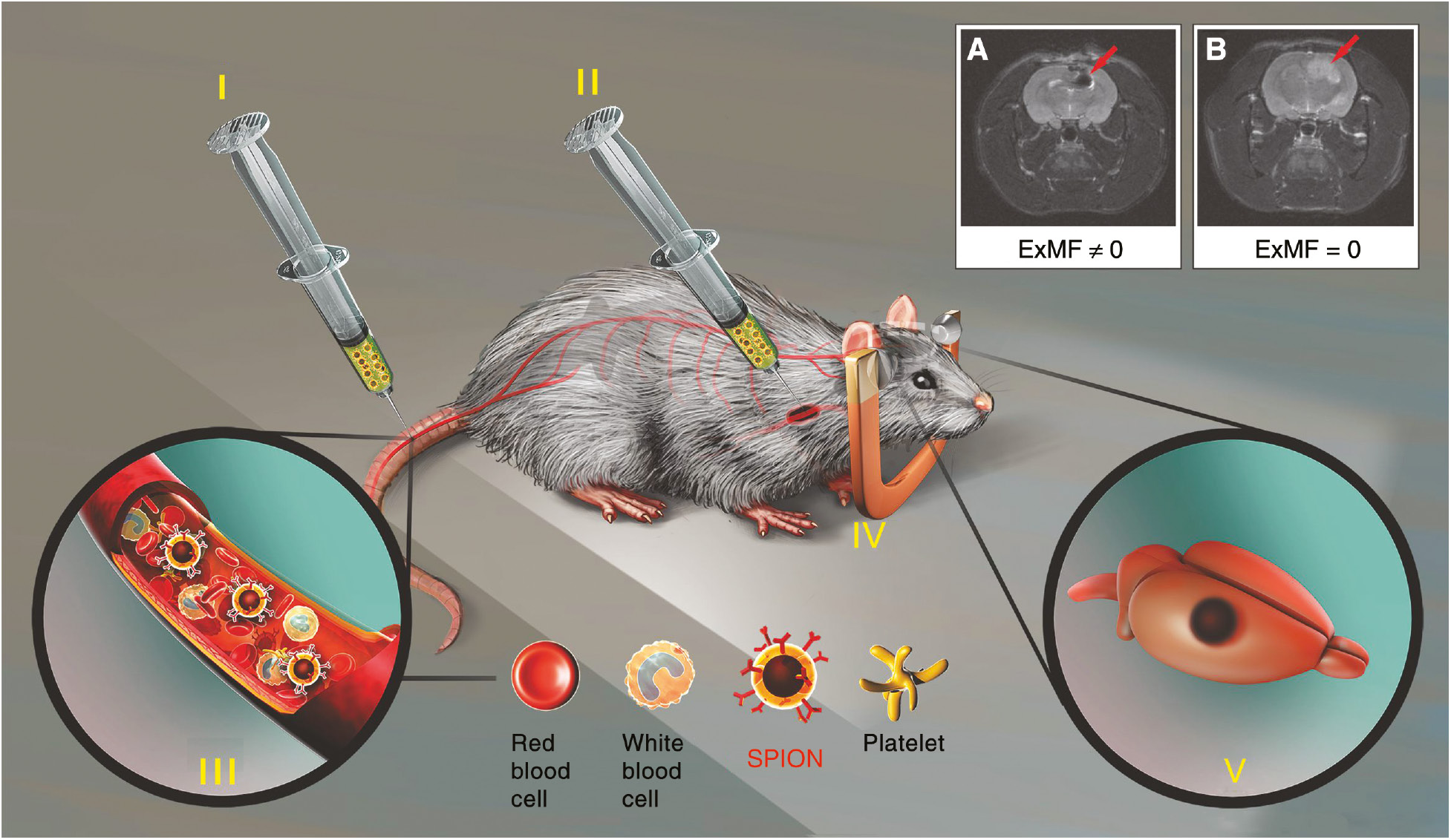 Figure 1: Representation of in vivo magnetic targeting using superparamagnetic iron oxide nanoparticles (SPIONs). The process begins with the SPIONs being administered caudally (I) or by carotid artery (II) and being transported by the blood flow (III). An external magnetic field (ExMF) is applied to target the tumor with SPION (IV), which are concentrated in the tumor tissue (V). MRI showing SPION accumulation (arrow) in tumor with (A) and without (B) ExMF. The illustrations are not drawn to scale.