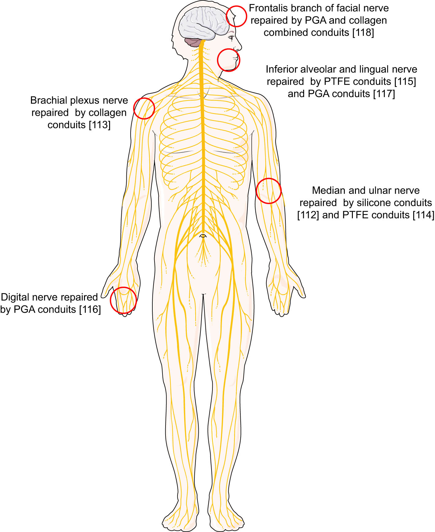 Figure 3
Schematic illustration of clinical trials of peripheral nerve repair with different types of nerve conduits at different anatomic regions.