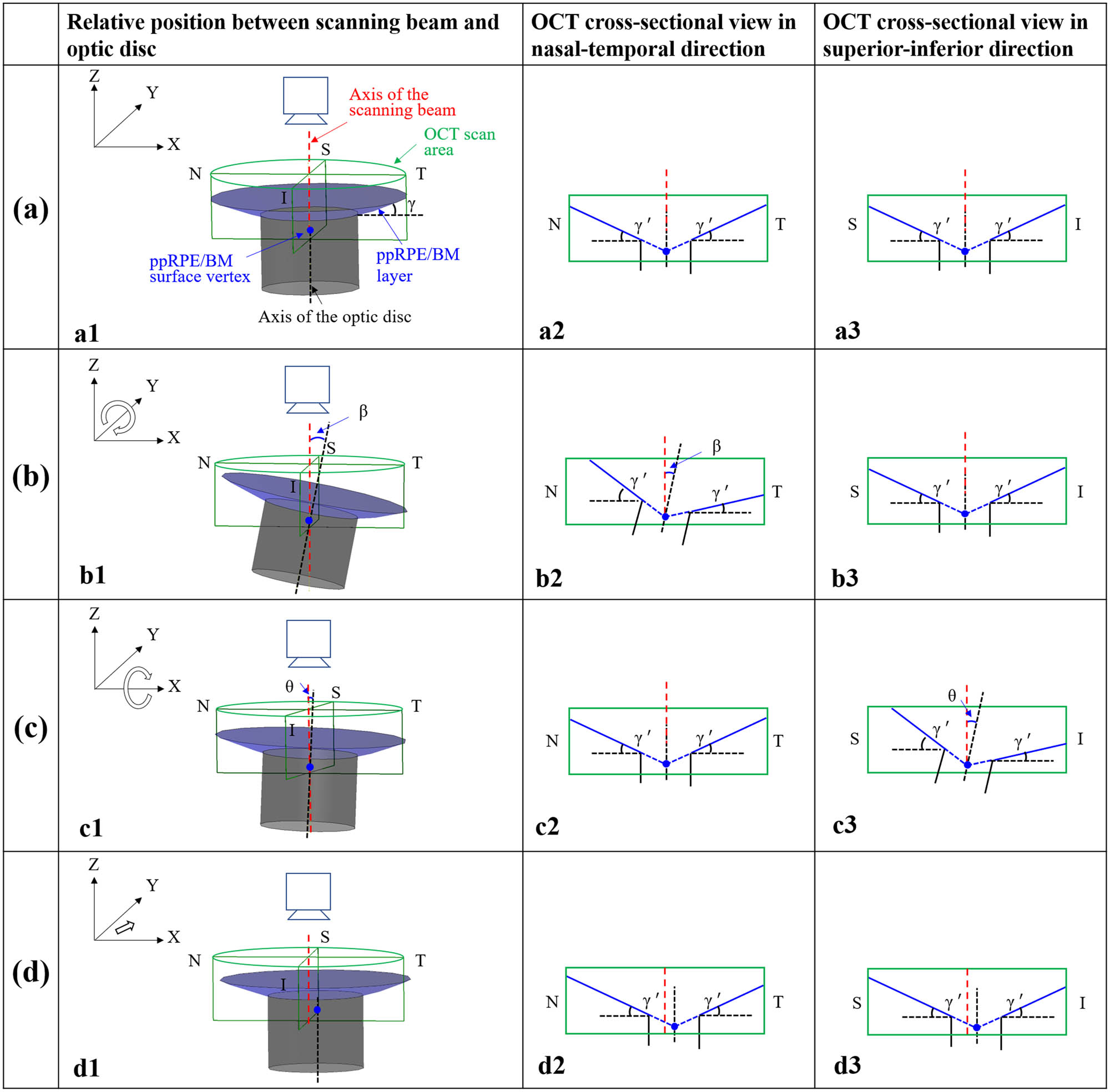 Figure 2 
                  Schematic diagrams of the ppRPE/BM layer morphology with columns: relative position between the OCT scanning beam and optic disc; the OCT cross-sectional view in nasal-temporal direction; and the OCT cross-sectional view in the superior-inferior direction. The ppRPE/BM layer angle (
                        
                           
                           
                              γ
                              ′
                           
                           \gamma ^{\prime} 
                        
                     ) refers to the angle between the ppRPE/BM layer and the horizontal plane of a 2D scan. (Row a) the axis of OCT scanning beam coincides with the axis of the optic disc; (Row b) case with a tilt angle (β) between the axis of OCT scanning beam and the axis of the optic disc in the nasal-temporal direction; (Row c): case with a tilt angle (θ) between the axis of OCT scanning beam and the axis of the optic disc in the superior-inferior direction; (Row d) the axis of OCT scanning beam is parallel with the axis of the optic disc, with the ppRPE/BM surface vertex off the axis of the scanning beam. S, I, N, and T indicate superior, inferior, nasal, and temporal, respectively. The green box marks the OCT scanning area; the blue surface represents the ppRPE/BM layer; the gray surface represents the optic nerve surface. The red dash line represents the axis of the scanning beam, and the black dash line represents the axis of the optic disc. The blue line represents the ppRPE/BM layer in the 2D view, with the blue dashed line as the extended ppRPE/BM layer. The blue dot represents the conical vertex of the ppRPE/BM surface.
               