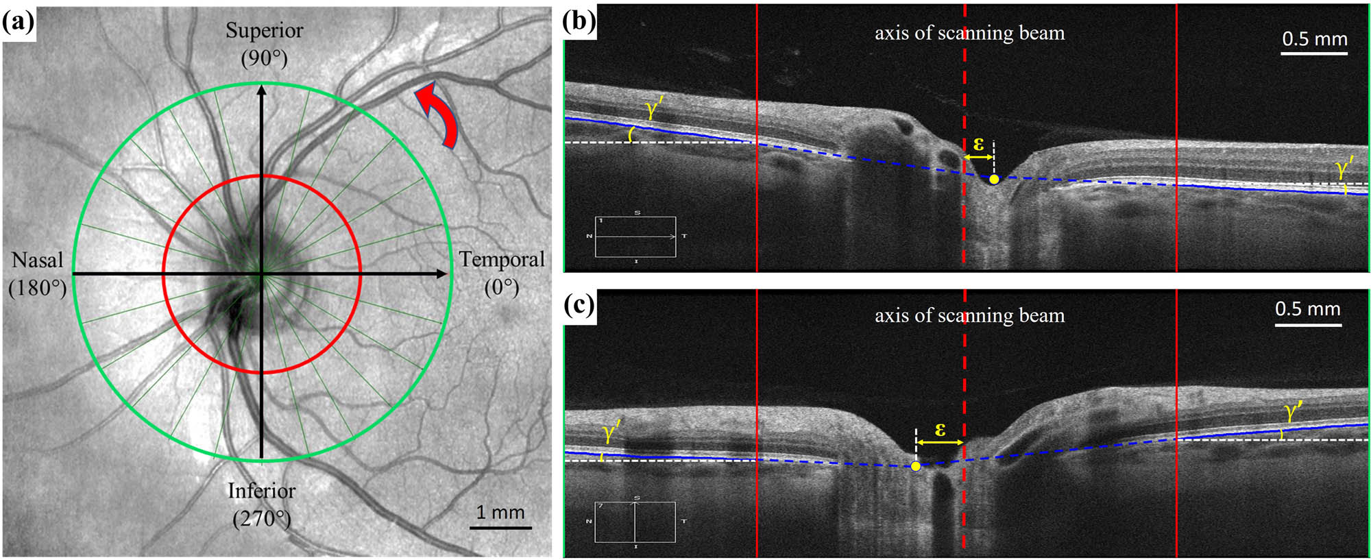Figure 3 
                  (a) Enface projection of the radial OCT centered over the optic disc. Twelve radial scans (green line) were acquired for each optic disc. The insert indicates the position of the corresponding scan shown in panel b (nasal-temporal direction) and panel c (superior-inferior direction). The red circle marks the inner boundary of the peripheral region of the optic disc for segmentation, and the green circle marks the outer boundary of the OCT scan. The radial position of the scan was assigned counterclockwise (marked with red circle arrow) starting from 0° at the temporal direction. (b) The ppRPE/BM layer angle (
                        
                           
                           
                              γ
                              ′
                           
                           \gamma ^{\prime} 
                        
                     ) and the eccentric distance (ε) in OCT scan at the nasal-temporal direction. (c) The ppRPE/BM layer angle (
                        
                           
                           
                              γ
                              ′
                           
                           \gamma ^{\prime} 
                        
                     ) and the eccentric distance (ε) in OCT scan at the superior-inferior direction. In panels b and c, the red line marks the inner boundary of the ppRPE/BM layer, and the green vertical boarder marks the outer boundary of the ppRPE/BM layer. The solid blue line highlights the portion of the ppRPE/BM layer analyzed in this study, and the dashed blue line marks the extension of the ppRPE/BM layer. The dashed red line indicates the axis of the scanning beam. The solid yellow dot is the intersection point of the two extended lines (dashed blue line) of the ppRPE/BM layer.
               