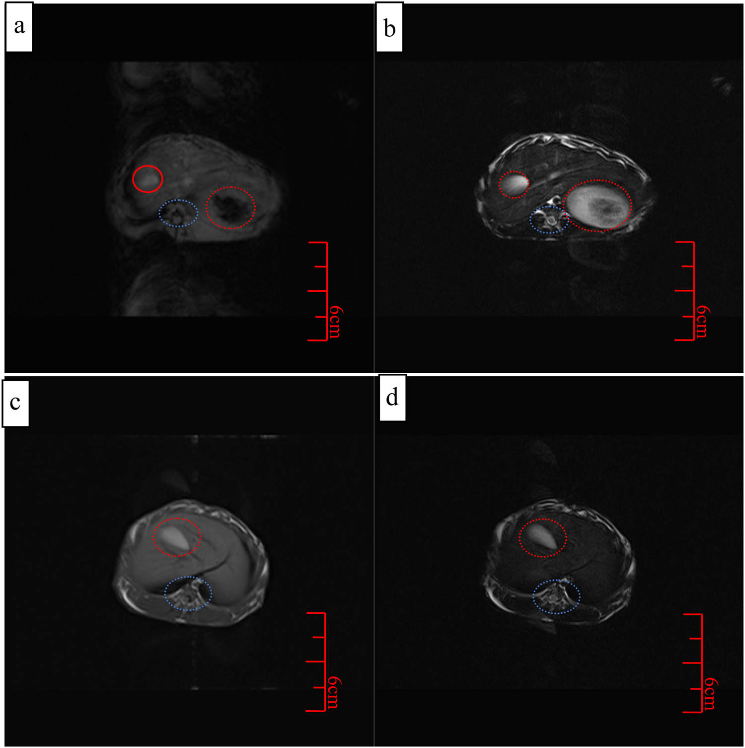 Figure 8 
                     Simultaneous T
                        1- and T
                        2-weighted coronal images of Fe3O4@DDT-PMAA MFs in rabbit liver cancer, (a) pre-rejection for T
                        1 images; (b) after-rejection for T
                        1 images; (c) pre-rejection for T
                        2 images; and (d) after-rejection for T
                        2 images.
                  