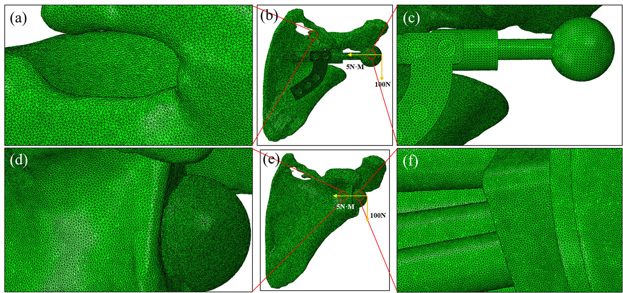 Figure 2 
                  Mesh division and load application before finite element analysis. (a–c) Mesh chart of the personalized prosthesis and scapula matching model and the corresponding enlarged views. (d–f) Mesh chart of the traditional prosthesis and scapula matching model and the corresponding enlarged views.
               